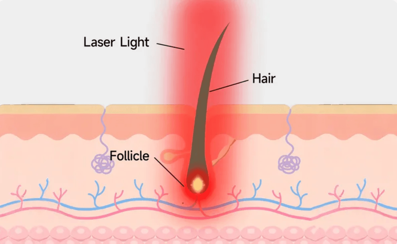 Diagram: red laser light reaching the hair follicle beneath the skin
